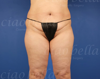 liposuction bodysculpting case#165