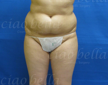 Liposuction Bodysculpting case#1009